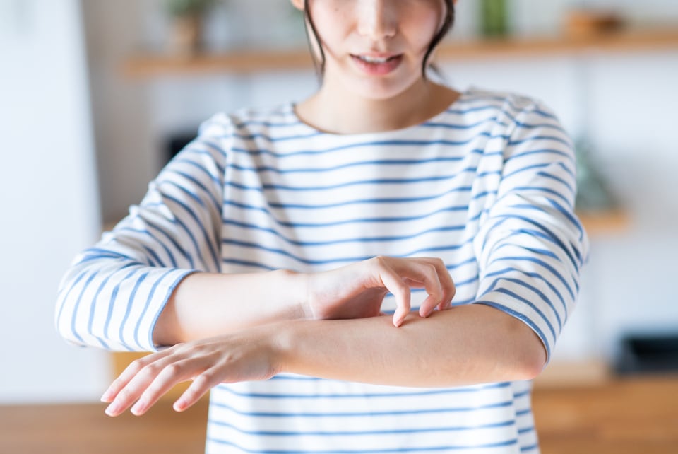 接触性アレルゲンによる皮膚疾患に悩む女性